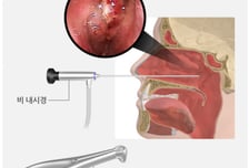 "감기 아니었어" 어쩐지 콧물이 노란색...뇌막염 부르는 '이 질환'