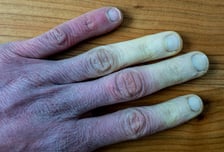 장갑 안 낀 손가락, 하양→파랑→빨강…추울 때 피부 썩는 '이 병'