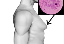 유방암 걸린 남성, 16년새 2배 늘었는데 생존율 정체…"독립연구 필요"