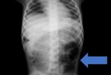 "배 아파" 떼쓰는 여아, 위·소장에 털뭉치 '가득'...라푼젤 증후군 탓
