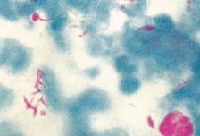 한센병, '1회' 치료에 억제율 99.9%…'관리할 수 있는' 질병