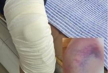 190cm·120kg 고교생의 로킥…전치 6주 나왔는데 "장난이었다"