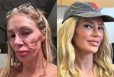 "기생충 얼굴 감염" 고통 호소한 모델…'2억' 치료 끝 달라진 근황