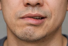 얼굴 한쪽 마비, 이마 주름 안 생겨…72시간이 골든타임인 '이 병'