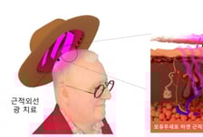 탈모인 한 줄기 '빛'…"모자인줄" 탈모 억제 92% 치료기 개발
