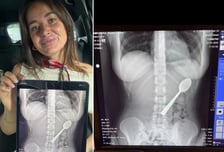 반려견에 놀라 '17㎝ 숟가락' 꿀꺽…엑스레이 사진 보니 아찔