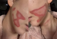 권민아 얼굴에 새빨간 화상..."공황발작, 엄마도 눈물" 피부과서 무슨일