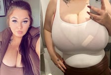 "가슴만 32㎏" 피부 찢어져 감염됐는데 '축소술 거부' 당한 20대 영국 여성