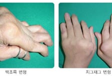 아침만 되면 손가락 '뻣뻣'… 방치했더니 꼬부랑 손가락 됐다?