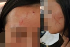 "얼굴 물어뜯고 머리 '퍽'→생살 꿰맸다"…악몽 된 가족여행, 무슨 일?