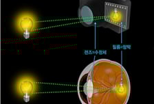 눈 검사받다가 파킨슨병 진단…망막 변화로 조기진단 단서 찾았다