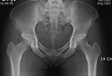 방치하면 사망률 70%인데…"뼈 수술 NO" 환자 퇴짜 놓는 병원, 왜?