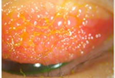 건조하고 미세먼지+꽃가루...눈물나는 봄날, 3대 안과 질환 '꿀팁'