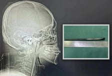 목 안에 '12cm' 젓가락 박혀 있는데...안 빼고 8년 버틴 남성