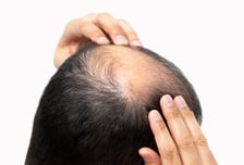 "탈모약 먹고 싶어도 '정력 감퇴' 걱정"...부작용 해결 물질 찾았다