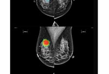 日폐암·유방암 X선 검진에 '의료 AI' 논의…'현지 직판' 나선 곳은