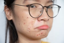 "나이 마흔살에 여드름이…ㅠㅠ" 봄철 얼굴 망치는 뜻밖의 원인