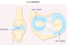 "무릎 뼈 모양, 연골판 이식 결과에 영향" 건대병원, 108명 분석했더니