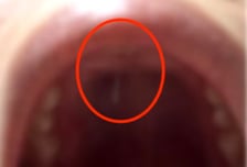 코 성형수술 후 입천장 뚫고 나온 '철심'…병원 측은 "별거 아냐"