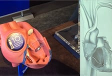 "한 번 시술로 평생 사용" 무전극선 심박동기 '마이크라' 신제품 출시