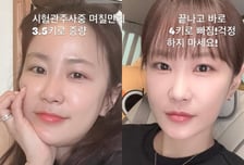 '김준호♥' 김지민, 시험관 시술 부작용…"살벌하게 부어"