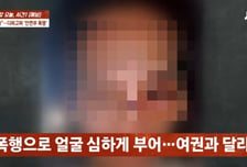 "한국인 남성들이 집단폭행" 코뼈 골절, 시력 뚝...필리핀서 무슨 일