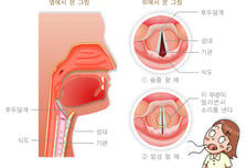 "목소리 안 나와" 목구멍 들여다보니 '이것' 자라…"2주 넘기지 말아야"