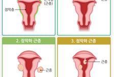 "생리통이겠지" 넘겼는데 날벼락..."아기 낳기 힘들다" 이 병 급증