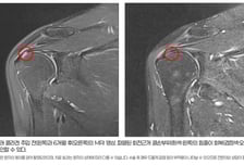어깨 통증 주범 '회전근개 파열'…'이것' 넣자 83%서 힘줄 되살아나