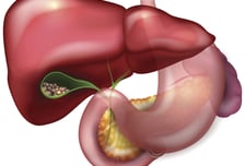 증상 보일 땐 손 못 쓴다? "80%는 수술도 못 해"...'이 암' 최선의 예방법은