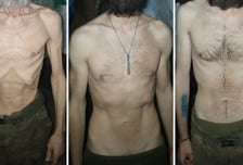 "몸무게 반토막, 17일간 굶었다"…우크라 병사들 영양실조 '충격'