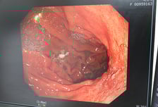 위암, 수술받았는데 또 생겼다? "완치했어도 '이것' 없애야" 의사 조언