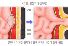 "쑥 나왔다, 누우면 사라지는 혹"...장 썩는 '도깨비 병' 뭐길래