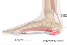 "발바닥 통증·기능 개선"… 족저근막염 새 치료법 'PRP 주사' 뭐길래