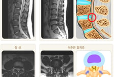 뒤로 젖혔다가 "아악"… 허리디스크로 착각 쉬운 '꼬부랑 할머니병'