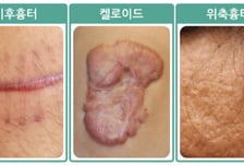여드름 난 턱선에 '팥알' 덕지덕지… 흉터 지나간 자리 지우려면