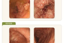 복통·설사·혈변에 체중 감소까지? 3개월 넘었다면 '이 병' 의심