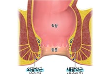 항문에 '이것' 넣었다가..."대장 뚫렸다" 40대남성 엽기행위 충격[한 장으로 보는 건강]