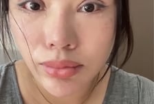 "평생 눈 못 감아" 쌍꺼풀 수술 부작용 폭로...중국 병원 실체 '충격'