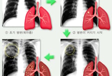 "재채기로 옮겨 사망" 한국서 고개 드는 '후진국 병' 5년간 20만명 육박