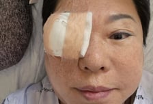 한 쪽 눈 가리고 "누워 있어야"...양희은 받은 '각막이식'은 어떤 수술?