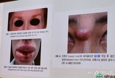 "점 그냥 빼면 됩니다, 의사 말 믿었더니 암"...'가짜 피부과' 구별법