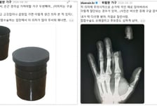 "고깃집서 손가락 잘린 환자만 5명"…'이런 의자 조심' 의사의 경고