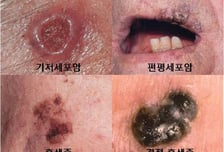 이게 점이야 암이야?...흑색종 구분하는 'ABCDE'