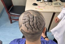 뇌처럼 변한 울퉁불퉁 두피…대수술 끝에 희소 질환 극복한 청년