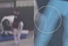 "몸부림 쳐도 강제 다리찢기" 7살 대퇴골 골절...태권도 관장 "집중 안해서"