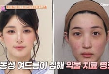 율희, 여드름에 안면비대칭…망가진 피부 보니 '깜짝'