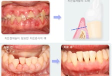 "칫솔질 세게 했나" 피 뚝뚝...알고보니 잇몸뼈 녹는 신호?