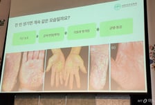 "손 피부가 왜 이러지" 4명 중 1명, 약국부터 찾는다…전문가 경고