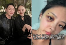 결혼식 코앞인데…'유현철과 재혼' 김슬기 멍든 눈에 "무슨 일이세요"